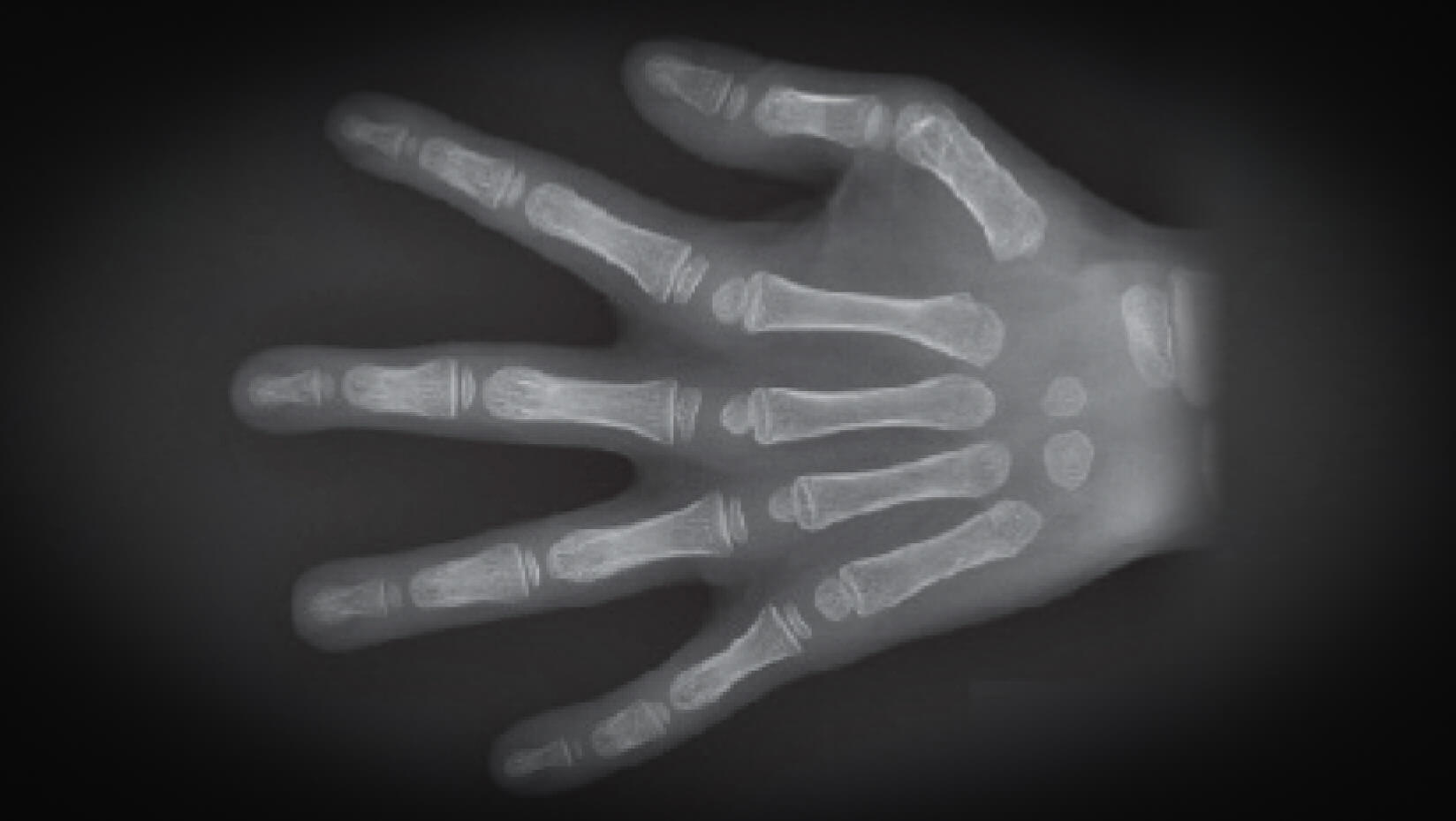 X-ray of hand